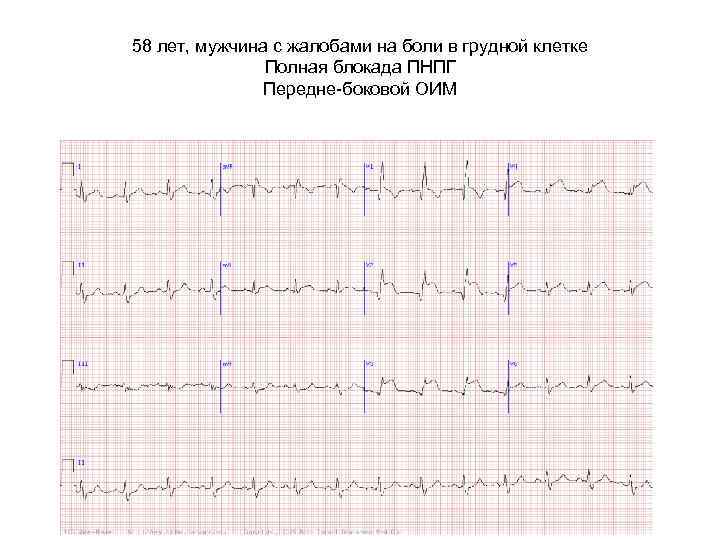 58 лет, мужчина с жалобами на боли в грудной клетке Полная блокада ПНПГ Передне-боковой