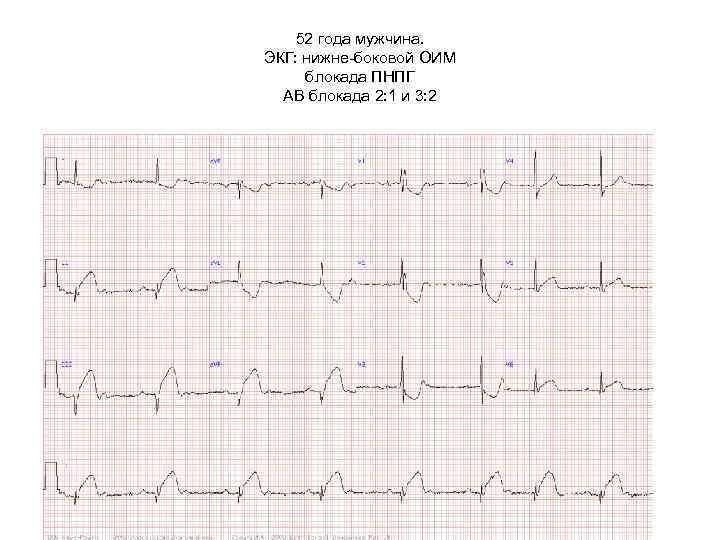 52 года мужчина. ЭКГ: нижне-боковой ОИМ блокада ПНПГ АВ блокада 2: 1 и 3: