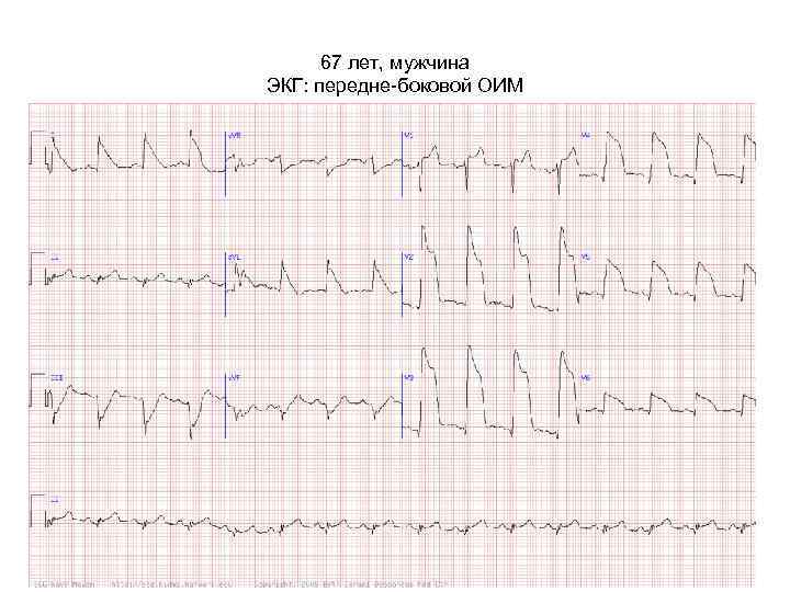 67 лет, мужчина ЭКГ: передне-боковой ОИМ 