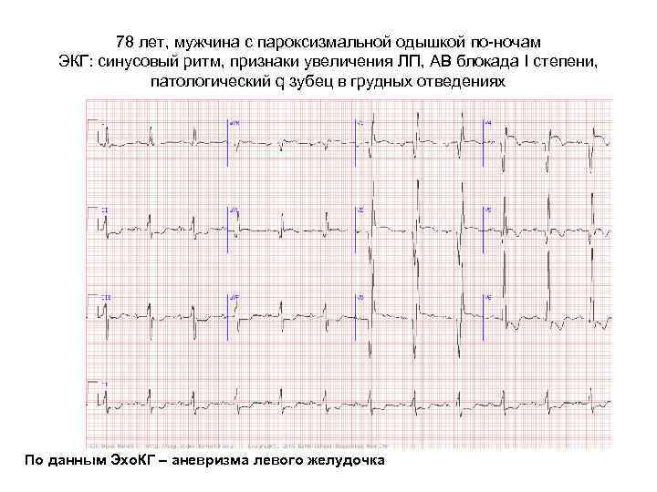 78 лет, мужчина с пароксизмальной одышкой по-ночам ЭКГ: синусовый ритм, признаки увеличения ЛП, АВ