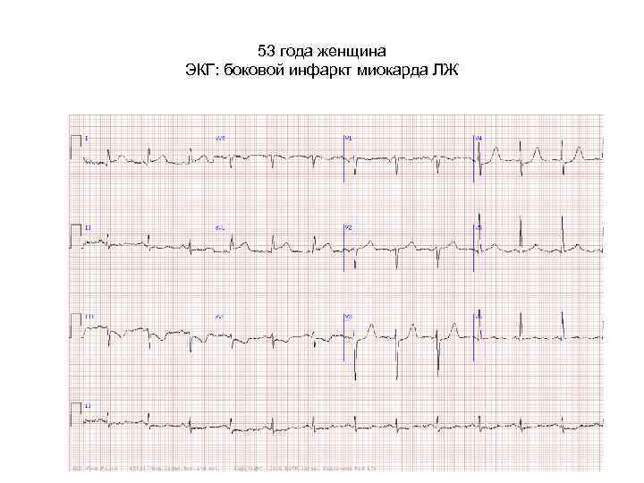 53 года женщина ЭКГ: боковой инфаркт миокарда ЛЖ 