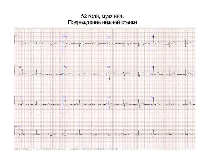 52 года, мужчина. Повреждение нижней стенки 