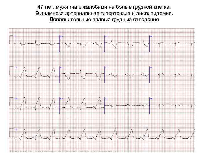 47 лет, мужчина с жалобами на боль в грудной клетке. В анамнезе артериальная гипертензия