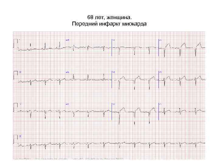 68 лет, женщина. Передний инфаркт миокарда 