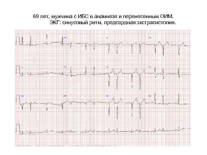 69 лет, мужчина с ИБС в анамнезе и перенесенным ОИМ. ЭКГ: синусовый ритм, предсердная