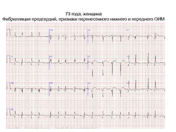 73 года, женщина Фибрилляция предсердий, признаки перенесенного нижнего и переднего ОИМ 