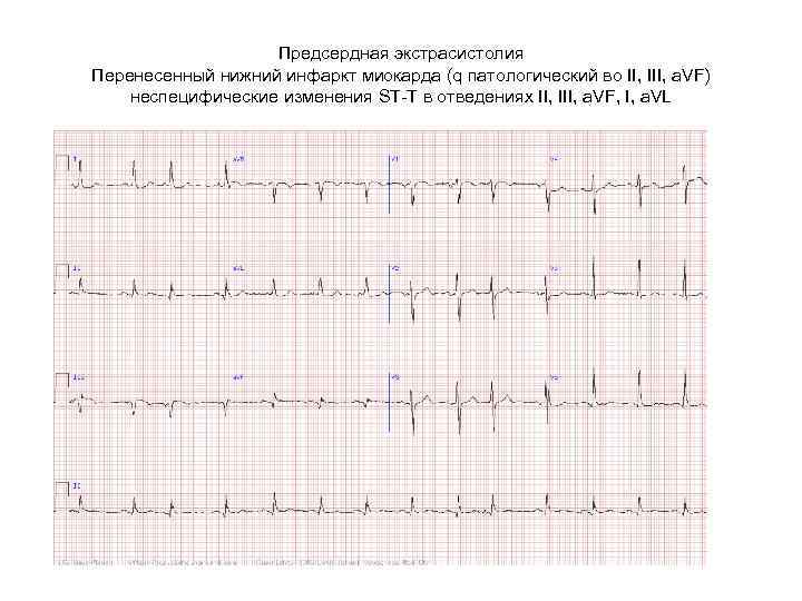 Предсердная экстрасистолия Перенесенный нижний инфаркт миокарда (q патологический во II, III, a. VF) неспецифические