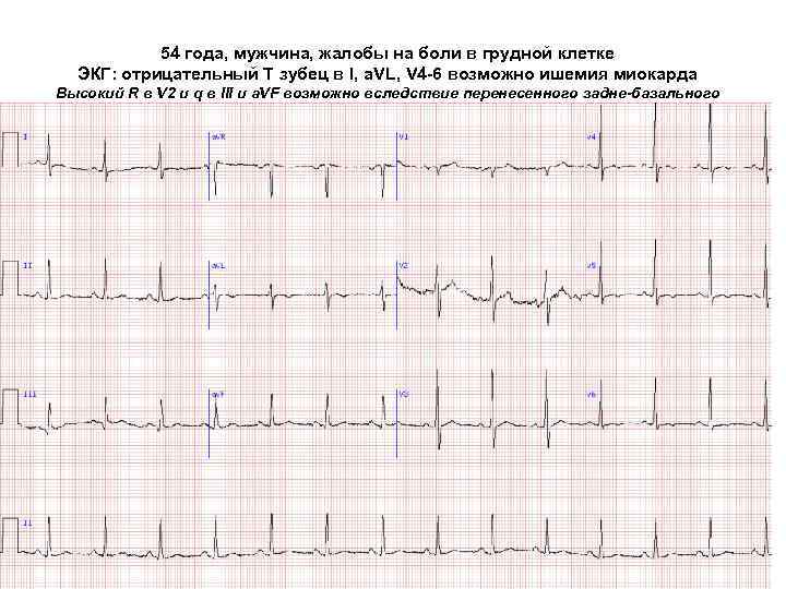 54 года, мужчина, жалобы на боли в грудной клетке ЭКГ: отрицательный Т зубец в