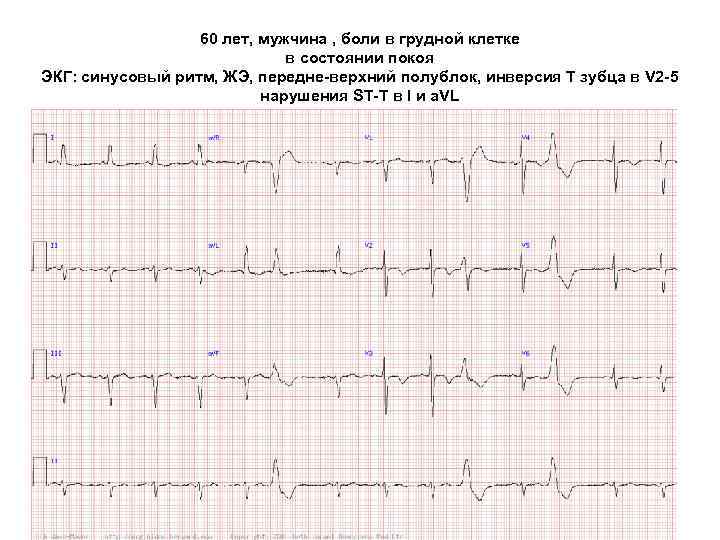 60 лет, мужчина , боли в грудной клетке в состоянии покоя ЭКГ: синусовый ритм,