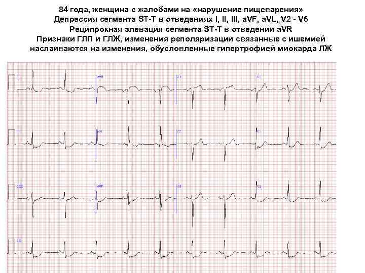 Подъем st в avl. Депрессии сегмента St в отведениях i, AVL, v1-v3. Элевация St в отведениях II, III, AVF. Элевация сегмента St на ЭКГ. Диагностически значимая депрессия сегмента St.