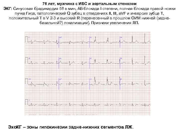 76 лет, мужчина c ИБС и аортальным стенозом ЭКГ: Синусовая брадикардия 58 в мин,