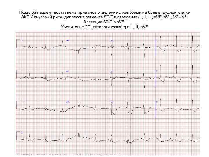 Пожилой пациент доставлен в приемное отделение с жалобами на боль в грудной клетке ЭКГ: