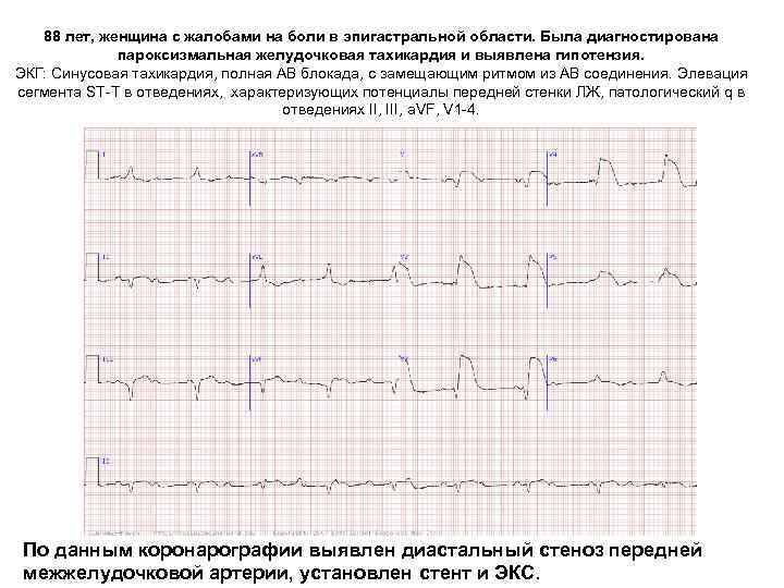 88 лет, женщина с жалобами на боли в эпигастральной области. Была диагностирована пароксизмальная желудочковая
