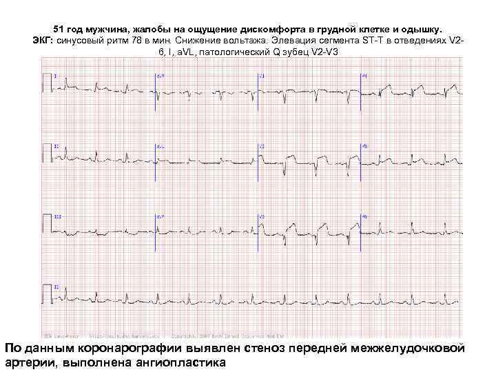 Элевация сегмента st что это. Снижение вольтажа на ЭКГ. Снижен Вольтаж зубцов ЭКГ В стандартных отведениях что это такое. Элевация St в грудных отведениях. Вольтаж ЭКГ норма.