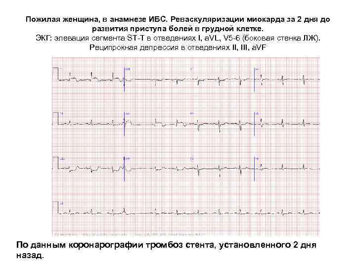 Пожилая женщина, в анамнезе ИБС. Реваскуляризации миокарда за 2 дня до развития приступа болей