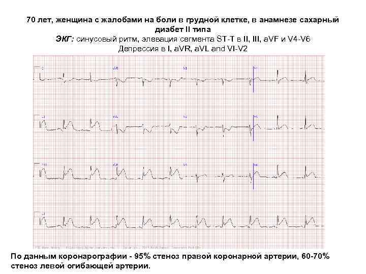 70 лет, женщина с жалобами на боли в грудной клетке, в анамнезе сахарный диабет