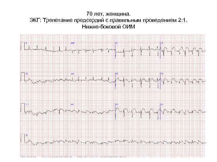 70 лет, женщина. ЭКГ: Трепетание предсердий с правильным проведением 2: 1. Нижне-боковой ОИМ 