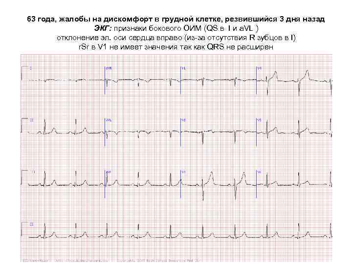 63 года, жалобы на дискомфорт в грудной клетке, резвившийся 3 дня назад ЭКГ: признаки