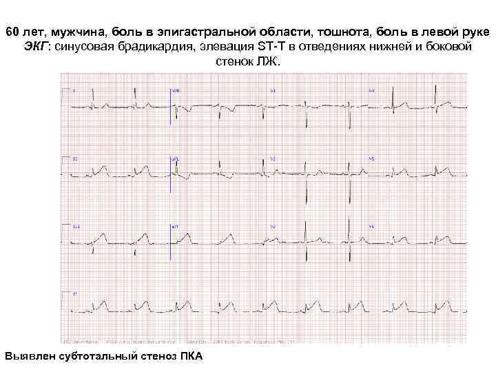 60 лет, мужчина, боль в эпигастральной области, тошнота, боль в левой руке ЭКГ: синусовая