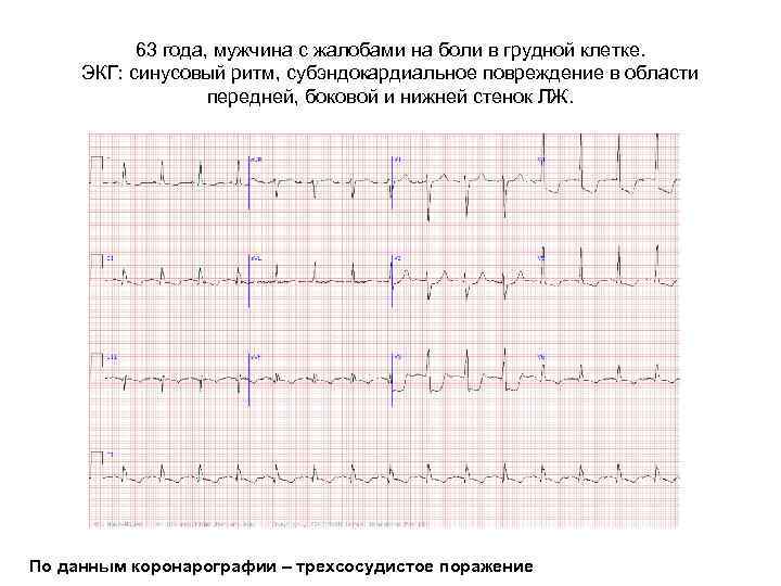 63 года, мужчина с жалобами на боли в грудной клетке. ЭКГ: синусовый ритм, субэндокардиальное