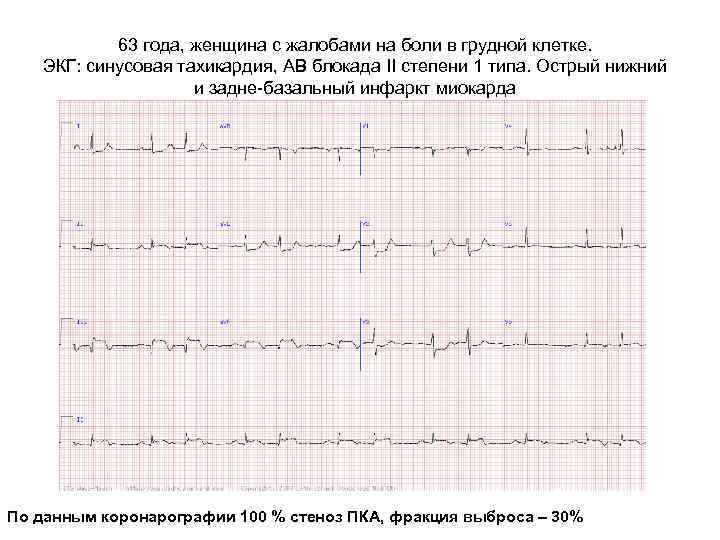 63 года, женщина с жалобами на боли в грудной клетке. ЭКГ: синусовая тахикардия, АВ