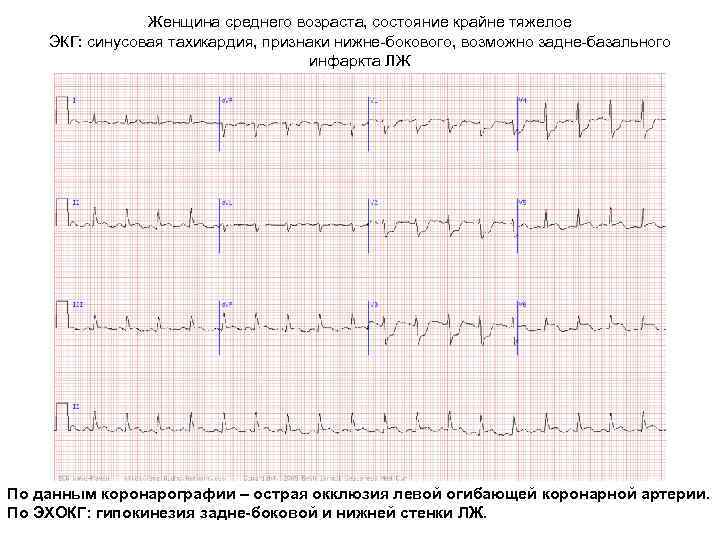 Женщина среднего возраста, состояние крайне тяжелое ЭКГ: синусовая тахикардия, признаки нижне-бокового, возможно задне-базального инфаркта