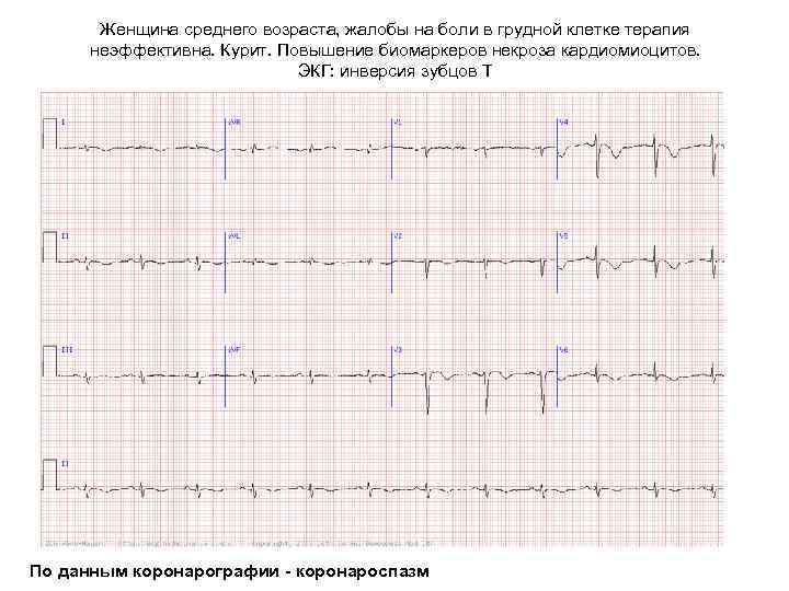 Женщина среднего возраста, жалобы на боли в грудной клетке терапия неэффективна. Курит. Повышение биомаркеров