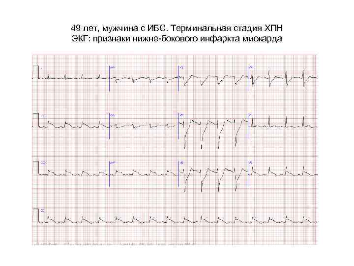 Боковой инфаркт на экг