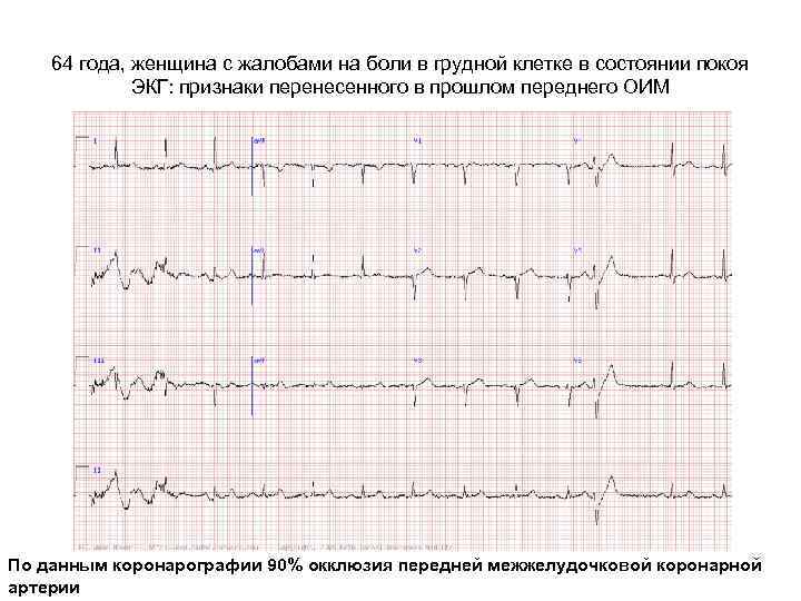 64 года, женщина с жалобами на боли в грудной клетке в состоянии покоя ЭКГ: