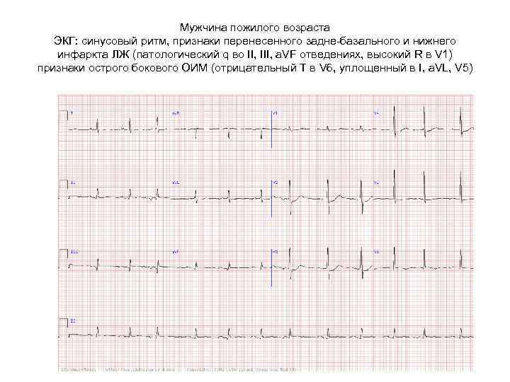 Мужчина пожилого возраста ЭКГ: синусовый ритм, признаки перенесенного задне-базального и нижнего инфаркта ЛЖ (патологический
