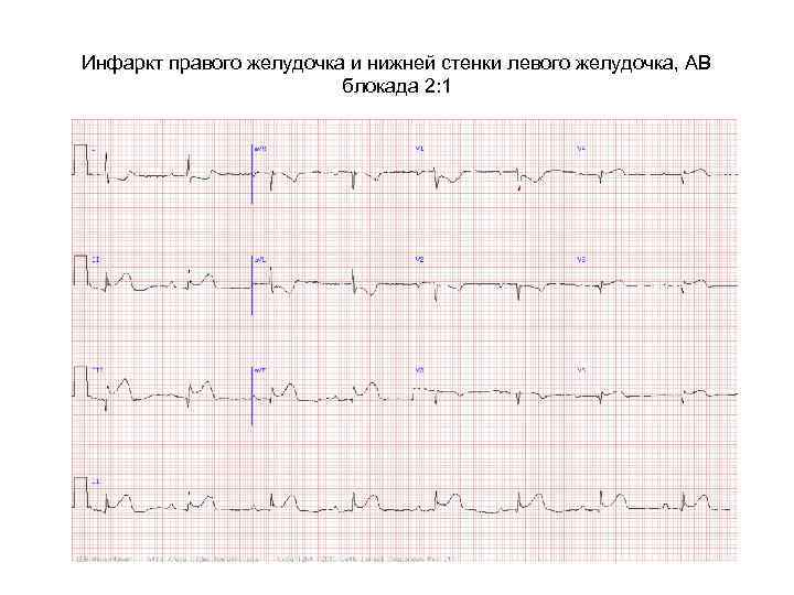 Блокада правого желудочка. Инфаркт правого желудочка на ЭКГ. Инфаркт правого желудочка.