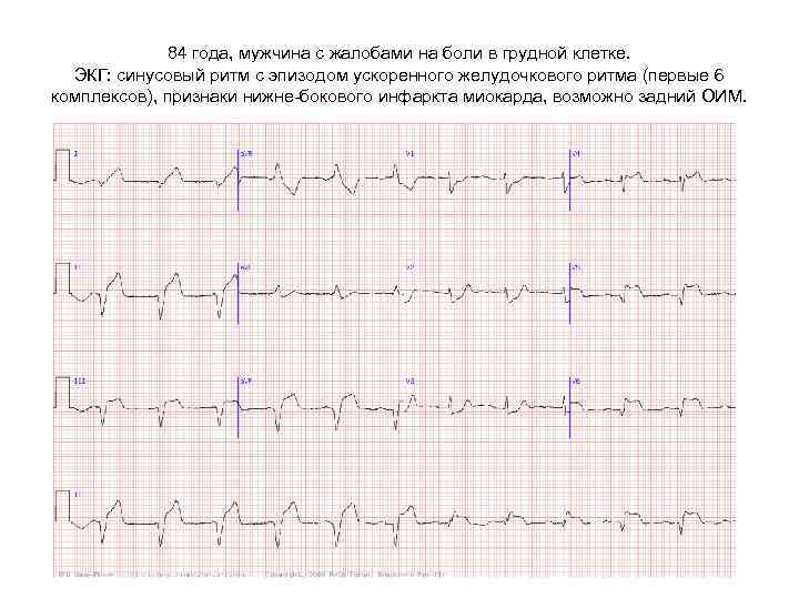 Умеренные изменения миокарда на экг