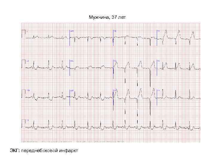Мужчина, 37 лет ЭКГ: переднебоковой инфаркт 