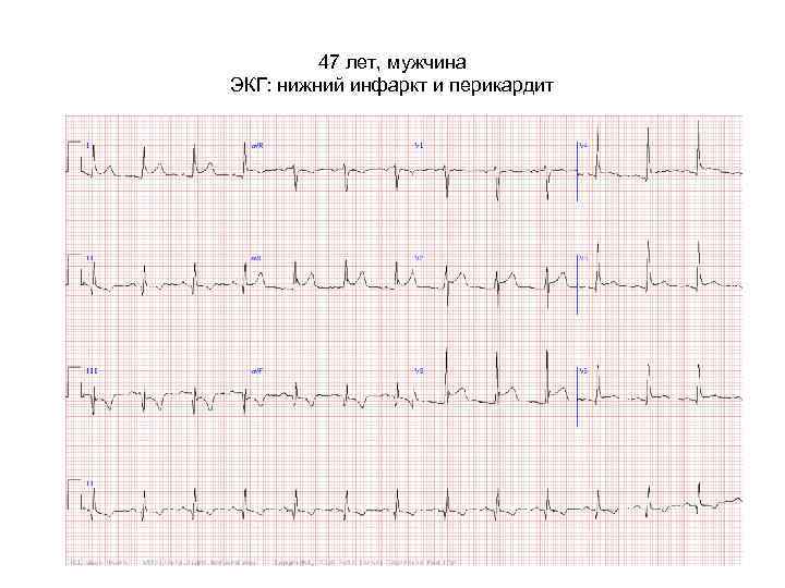 47 лет, мужчина ЭКГ: нижний инфаркт и перикардит 