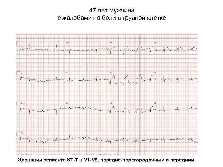 47 лет мужчина с жалобами на боли в грудной клетке Элевация сегмента ST-T в