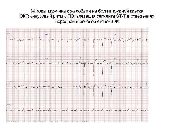 64 года, мужчина с жалобами на боли в грудной клетке ЭКГ: синусовый ритм с