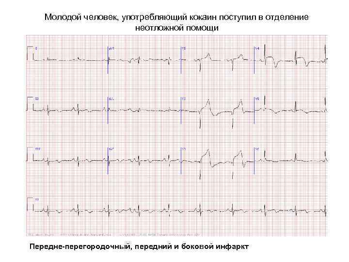 Молодой человек, употребляющий кокаин поступил в отделение неотложной помощи Передне-перегородочный, передний и боковой инфаркт