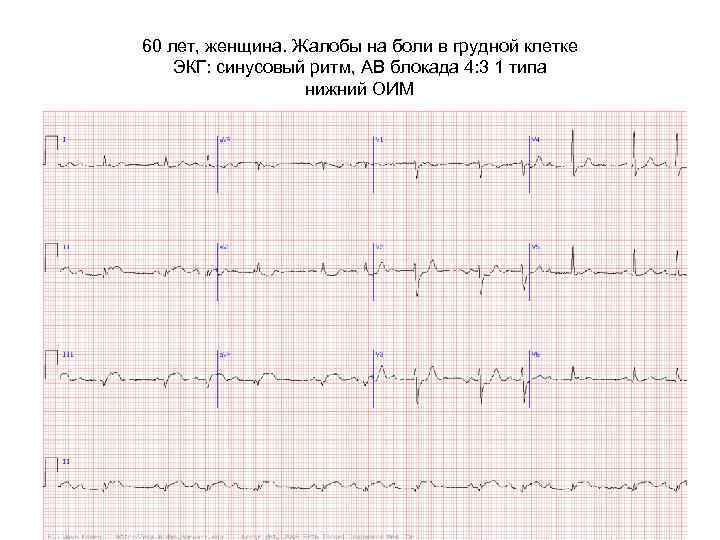 60 лет, женщина. Жалобы на боли в грудной клетке ЭКГ: синусовый ритм, АВ блокада
