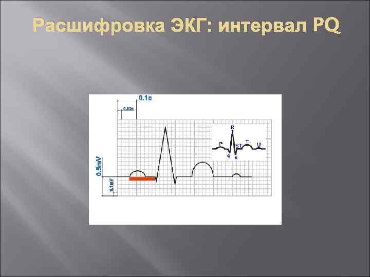 Расшифровка ЭКГ: интервал PQ 