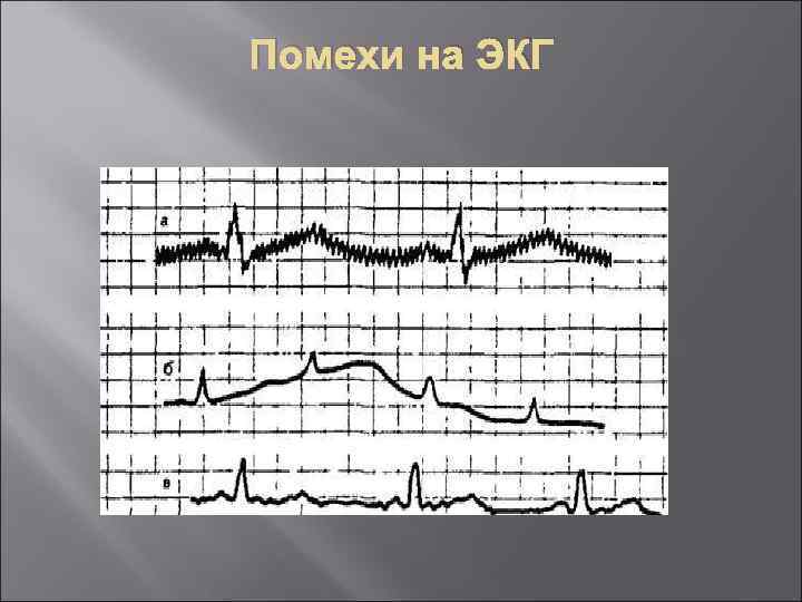 Помехи на ЭКГ 