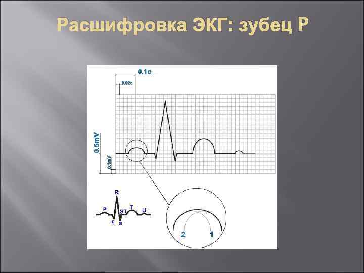 Экг зубец st