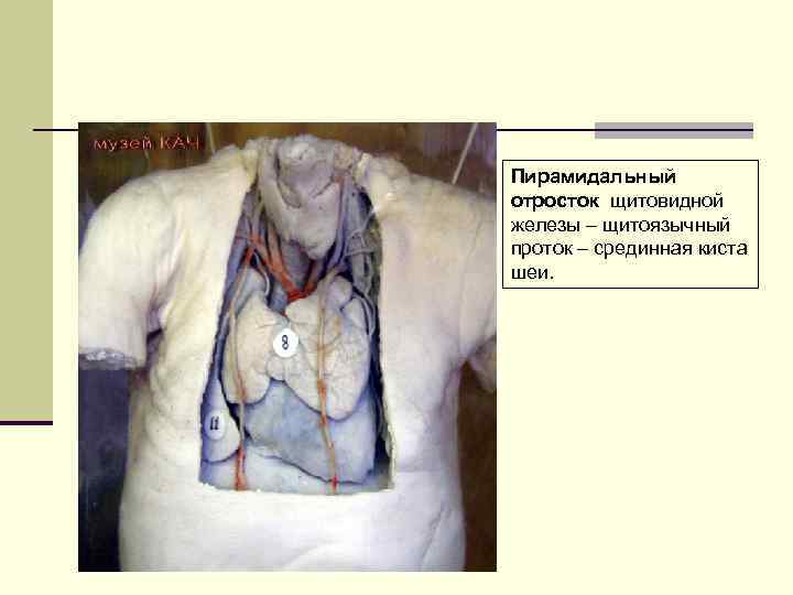 Пирамидальный отросток щитовидной железы – щитоязычный проток – срединная киста шеи. 