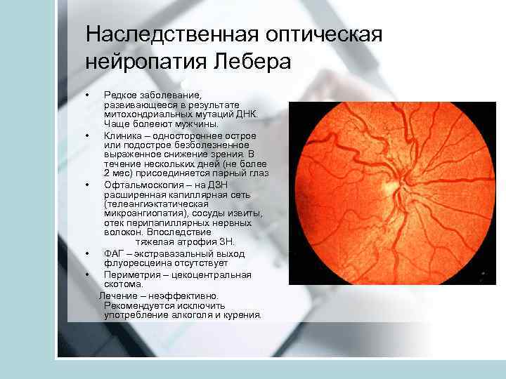 Нейропатия глаза. Зрительная атрофия Лебера. Атрофия зрительного нерва Тип наследования. Наследственная зрительного нерва Лебера.