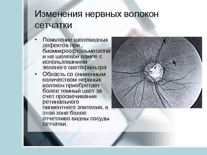 Толщина волокна. Слой нервных волокон сетчатки. Толщина перипапиллярного слоя нервных волокон. Толщина нервных волокон зрительного нерва норма. Толщина слоя нервных волокон сетчатки норма.