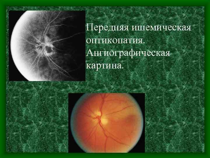 Передняя ишемическая оптикопатия. Ангиографическая картина. 