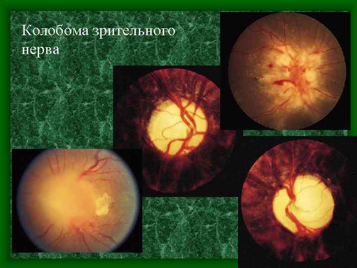 Колобома зрительного нерва 