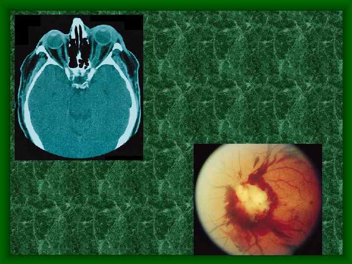 Аномалия развития зрительного нерва. Патология зрительного нерва. Врожденная аномалия диска зрительного нерва. Внутричерепная патология сосудистая. Врожденные нарушения зрительного нерва.