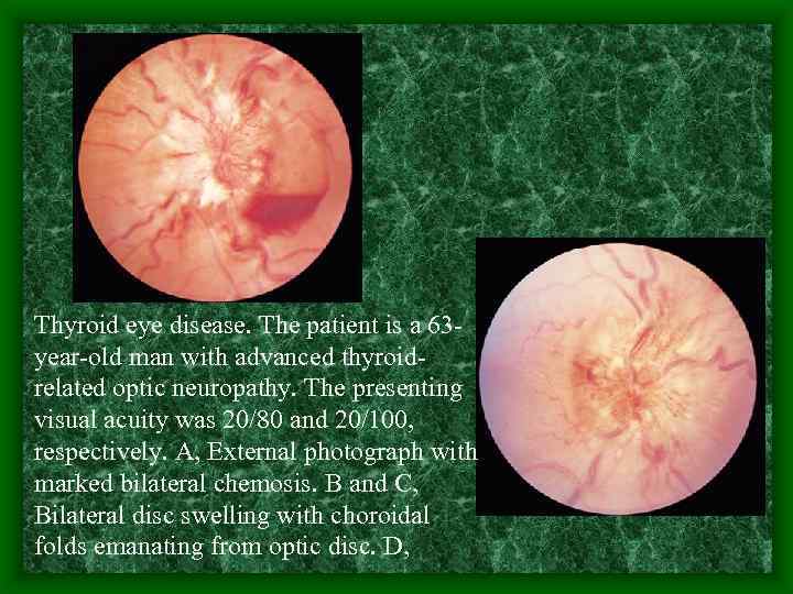 Thyroid eye disease. The patient is a 63 year-old man with advanced thyroidrelated optic