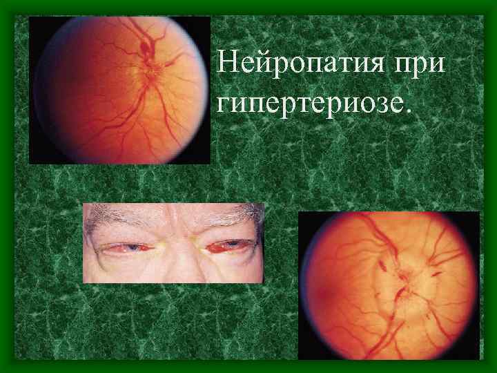 Нейропатия при гипертериозе. 