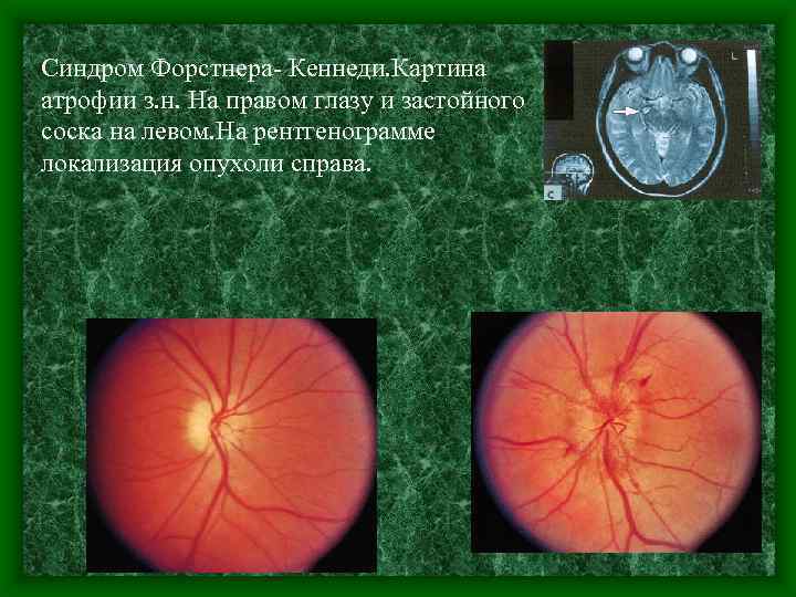 Синдром Форстнера- Кеннеди. Картина атрофии з. н. На правом глазу и застойного соска на